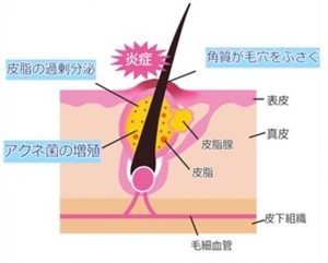毛穴の皮脂腺と皮脂