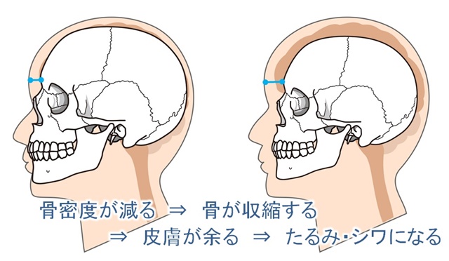 骨密度の低下は頭蓋骨の縮小となり皮膚のたるみ・シワへと繋がる